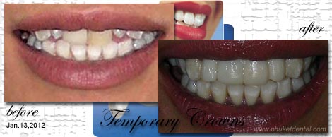 Temporary Crowns&Bridges at Phuket Dental Clinic,Thailand